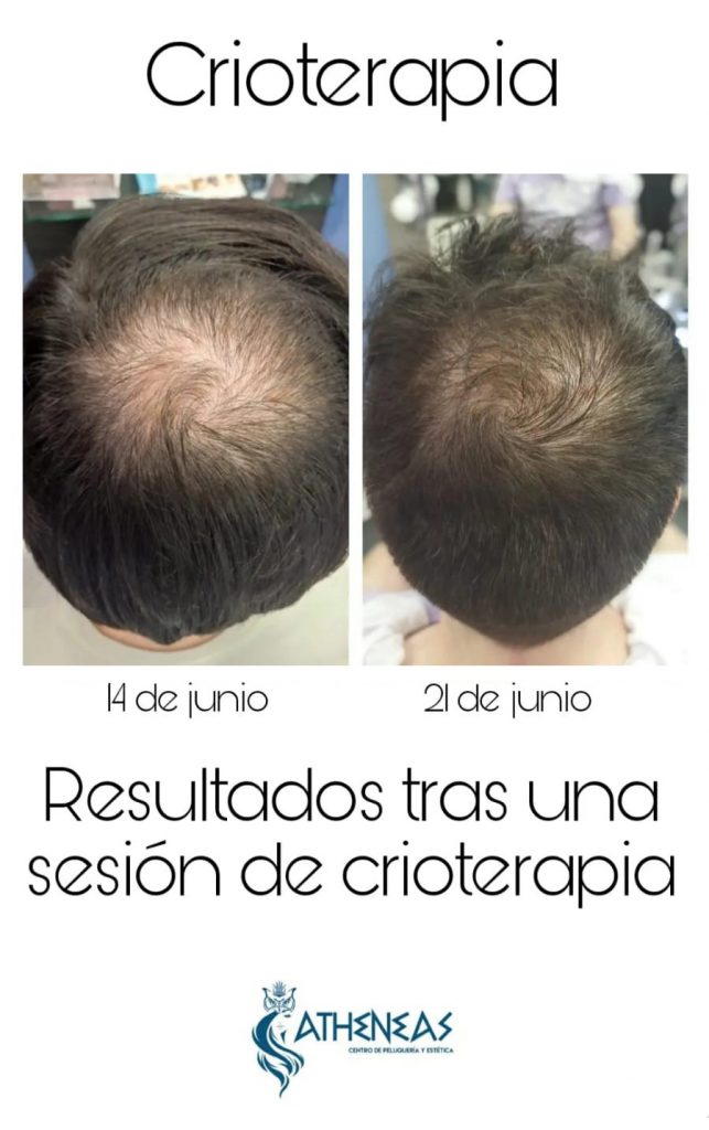 pelo,alopecia,crioterapia,peluqueria,atheneas,valladolid,resultados,vivedisfrutando